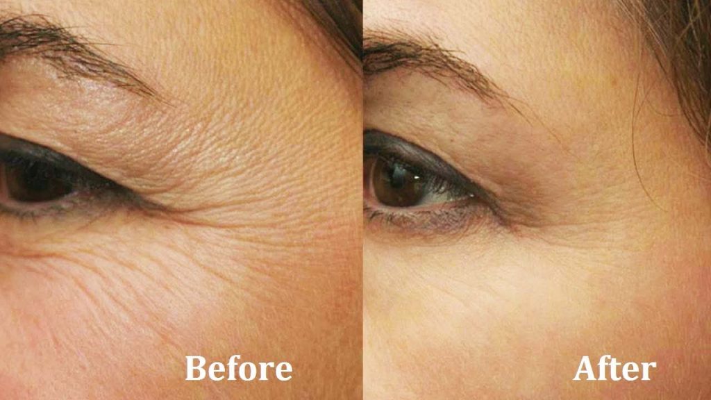 best treatment for under eye wrinkles