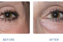 Best Treatment for Under Eye Wrinkles 2022 – Consumer Reports